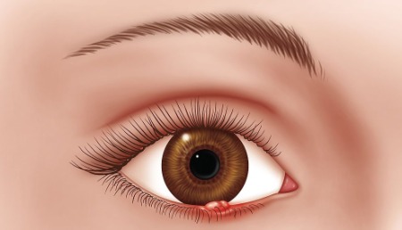 CHALAZION