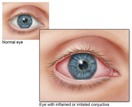 CONJUNCTIVITIS