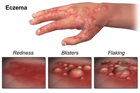 ECZEMA