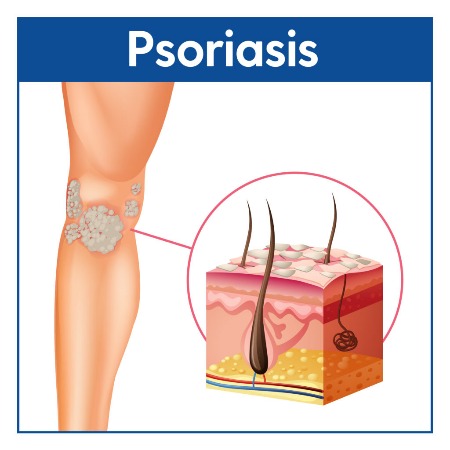 PSORIASIS